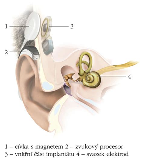 Obrázek znázorňující princip fungování kochleárního implantátu