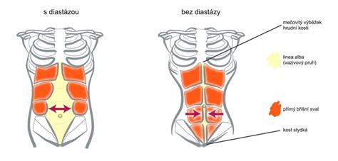 Ilustrace vrozených vad břišní stěny u dětí