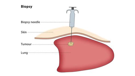 Proces biopsie nádorové tkáně