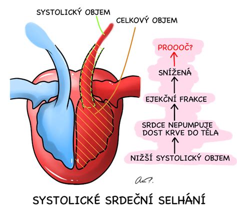 schematické znázornění otoků při pravostranném srdečním selhání