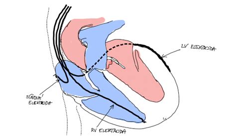 schéma implantace kardiostimulátoru pro srdeční resynchronizační terapii